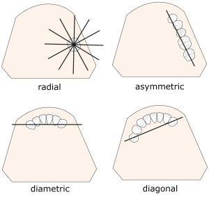 Figure 1-12. Fulcrum lines based on the position and number of abutment teeth on the arch.