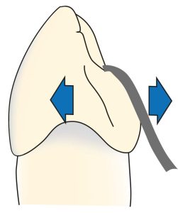 Figure 1-15. As the lingual surfaces of anterior teeth are inclined, the rest placement is difficult because the forces generate lateral forces on the inclined surfaces. When the prosthesis is under occlusal load, if the rest is on the inclined surface, the rest applies a tipping force labially to the abutment tooth, while sliding lingually, losing its proper position.