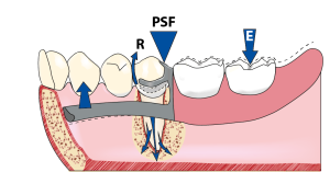 Figure 1-17a.Rotation towards the tissue in a first-class lever: When force (E) is applied to the base of the prosthesis in the occluso-gingival direction, the base moves towards the tissue around the fulcrum axis (PSF), while the anterior portion of the prosthesis (lingual bar) moves upwards. The clasp tip tries to move towards the survey line (R), exerting a tipping force on the abutment tooth.
