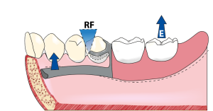 Figure 1-17b. Rotation away from the tissue in a first-class lever: When the denture base moves upwards due to the effect of sticky foods, the fulcrum (RF) shifts towards the clasp tip, and the anterior portion of the prosthesis (lingual bar) sinks towards the tissue.