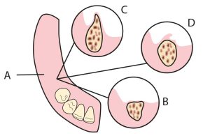 Figure 1-23. (A) Length of residual crest. (B) Flat crest: good support, poor stabilization. (C) Thin, knife-edge crest: poor support, poor stabilization. (D) Mobile mucosa over crest: poor support, poor stabilization.