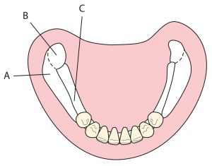 Figure 1-24. Supporting tissue areas for RPD in the mandible(A) Buccal shelf (primary support). (B) Retromolar pad (primary or secondary support depending on tissue density in the region). (C) Slopes of the residual crest (secondary support).