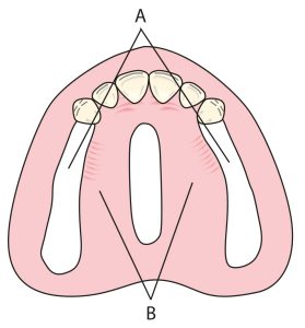 Figure 1-25. Supporting tissue areas for RPD in the maxilla(A) Posterior residual crestal areas (crestal crests: primary support, crestal slopes: secondary support). (B) Horizontal parts of the hard palate (primary support).