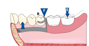 Figure 1-35a. Distal occlusal rest design.Effect of a First-Class Lever: The occlusal rest = fulcrum (F) at the center, the posterior region of the distal extension denture base = occlusal force (E), and the retentive tip of the clasp = resistance (R) at both ends.