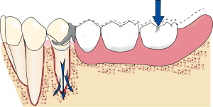 Figure 1-35b. Distal occlusal rest design. When force is applied to the distal extension denture base, rotational movement occurs around the distal occlusal rest and causes torque or tipping forces on the abutment tooth as the rigid clasp tip moves toward the survey line.