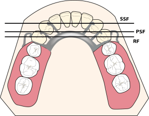 Figure 1-8. Types of fulcrum lines according to prosthetic components.RF: Retentive fulcrum, PSF: Primary stabilizing fulcrum, SSF: Secondary stabilizing fulcrum.
