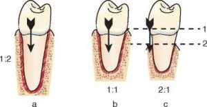 Figure 1-26. Crown-to-root ratio.a) 1:2. b) 1:1. c) 2:1. As the alveolar bone resorbs from the 1st line to the 2nd line level, the crown-to-root ratio increases.