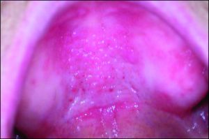 Figure 10-11. Irritation areas on the tissues supporting the prosthesis.