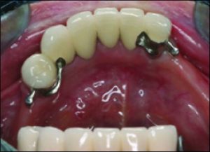Figures 10-12. Splinting anterior teeth in addition to canines and premolars provides resistance in the mediolateral direction.