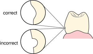 Figure 10-30. The recess must not have sharp corners, otherwise it will be difficult for the retentive clasp arm to engage and disengage in the retaining area.