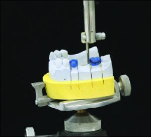 Figure 10-52. The cast with completed wax patterns of the crown restorations is placed on the surveyor in accordance with the path of insertion.