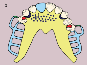 Figure 11.13. b) Metal framework design.
