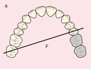 Figure 11.16. a) Class II: Diagonal fulcrum line passing through the terminal abutments of teeth 25 and 17.
