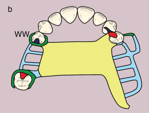 Figure 11.19. b) Metal framework design