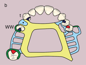 Figure 11.20. b) Metal framework design.