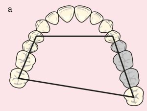 Figure 11.26. a) Class III: Quadrilateral support plane formed by the terminal abutments of teeth 24, 28, 14, and 17.