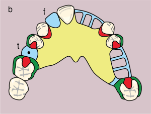 Figure 11.30. b) Metal framework design.