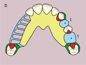 Figure 11.31. b) Metal framework design.