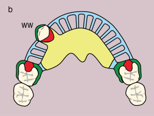 Figure 11.32. b) Metal framework design.