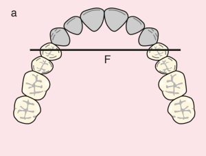 Şekil 11.33. a) Cl IV: Diametric fulcrum line passing through the terminal abutments of teeth 14 and 24.