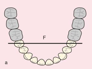 Figure 11.38. a) Cl I: Diametric fulcrum line passing through the terminal abutments of teeth 35 and 45.