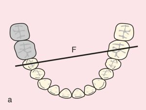Figure 11.42. a) Cl II: Diagonal fulcrum line passing through the terminal abutments of teeth 45 and 36.