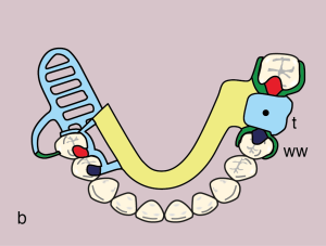 Figure 11.43. b) Metal framework design.