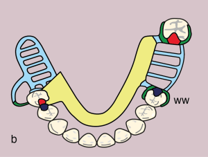 Figure 11.44. b) Metal framework design.