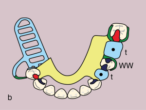Figure 11.45. b) Metal framework design.