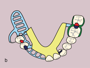 Figure 11.47. b) Metal framework design.