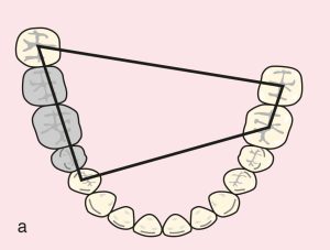Figure 11.49. a) Cl III: Quadrangular support plane between terminal abutments of teeth 44, 48, 36, and 36.