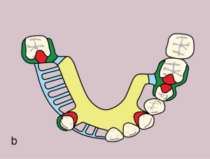 Figure 11.51. b) Metal framework design