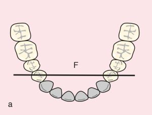 Figure 11.52. a) Cl IV: Diametric fulcrum axis passing through terminal abutments numbered 34 and 44.