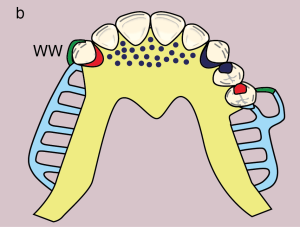 Figure 11.6. b)Metal framework design (Dotted area on the U-plate: Ruga support; indirect retention)