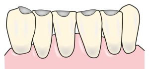 Figure 2-10. Labial view of incisal rests on the mandibular incisors and the right canine.