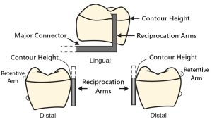 Figure 3-11. The vertical reciprocation arm exhibits minimal surface contact with the height of contour. The retentive and reciprocal arms make simultaneous contact with their respective tooth surfaces.