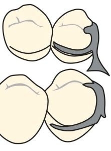Figure 3-13. Buccal and lingual views of a simple circumferential (Akers) clasp approaching the mesial undercut area of the abutment tooth from the edentulous space.