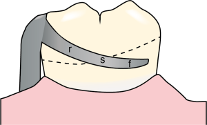 Figure 3-2. The retentive arm of a circumferential clasp is divided into three segments: the retentive tip is flexible (f) and positioned below the survey line; the middle one-third is semi-flexible (s); and the proximal one-third is rigid (r) and should be located above the survey line.