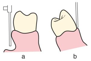 Figure 3-22. Factors limiting the use of bar clasps.a) Excessive soft tissue undercut, b) Excessive tilting of the supporting tooth towards the lingual or buccal.