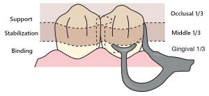 Figure 3-23. In the Y bar clasp, only one of the retentive terminals is positioned within the undercut area.