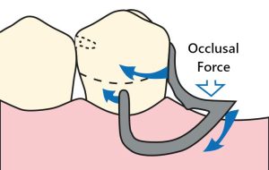 Figure 3-24. An I bar clasp design with appropriate tissue relief and a proximal plate extending to the middle and gingival thirds of the proximal surface helps distribute functional forces more evenly.