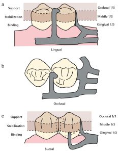 Figure 3-25. RPI clasp system: a) Support is provided by the occlusal rest. b) Stabilization is achieved by the occlusal rest and mesial and distal minor connectors. c) Retention is provided by the I-bar clasp. Reciprocity occurs due to the positioning of the minor connectors.