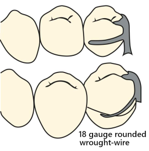 Figure 3-27. The combination clasp consists of a cast stabilization arm and a rounded, wire-wound retentive arm that tapers towards the tip.