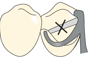 Figure 3-3. As the length of the clasp arm increases, its flexibility also increases. A clasp arm should not cover the tooth surface in a straight line, but should be curved as much as possible. The terminal portion of the clasp is directed towards the occlusal.