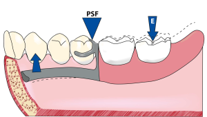 Figure 4-1. The rotation of the distal extension denture base toward the tissue around the primary stabilizing fulcrum (PSF) line is restricted by the denture base itself; this type of movement cannot be controlled by the indirect retainer.