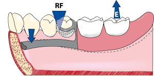 Figure 4-2a. When a force is applied to the distal extension denture base in a direction away from the tissue, the fulcrum shifts from the occlusal rest to the retentive arm of the clasp (Retentive Fulcrum: RF).