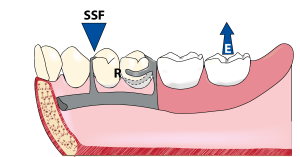 Şekil 4-2.b) Fulkrum hattının ön bölgesine yerleştirilen bir indirekt tutucu, kaldırıcı yöndeki kuvvetlere karşı destek oluşturarak, protez kaidesini stabilize eder. İndirekt tutucu fulkrumu (Sekonder Dengeleyici Fulkrum: SDF) oluştururken, kroşenin tutucu ucu da direnç (D) göstererek, indirekt tutucuya yardımcı olur ve ikinci sınıf kaldıraç oluşur.