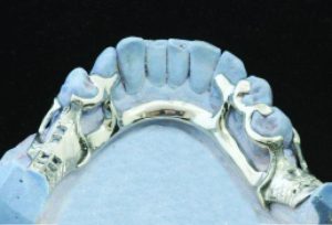 Figure 4-4. The indirect retainer in the form of a canine extension is used in conjunction with a mesio-occlusal rest on the mesial marginal ridge of the first premolar.