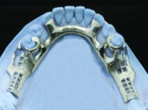 Figure 4-5. Bilaterally used cingulum rests functioning as indirect retainers.