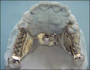 Figure 5-1. A palatal strap major connector may be narrower in tooth-supported cases such as Class III with modifications.